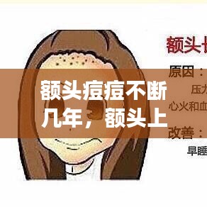 额头痘痘不断几年,额头上长痘痘好几年是什么原因引起的