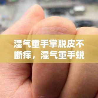 湿气重手掌脱皮不断痒,湿气重手蜕皮