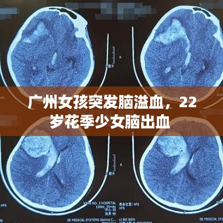 广州女孩突发脑溢血,22岁花季少女脑出血