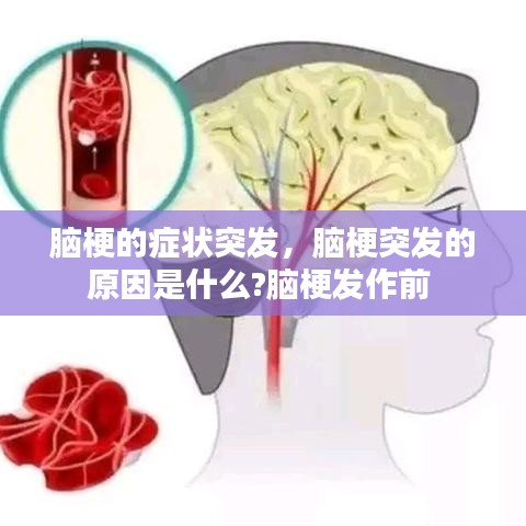 脑梗的症状突发,脑梗突发的原因是什么?脑梗发作前